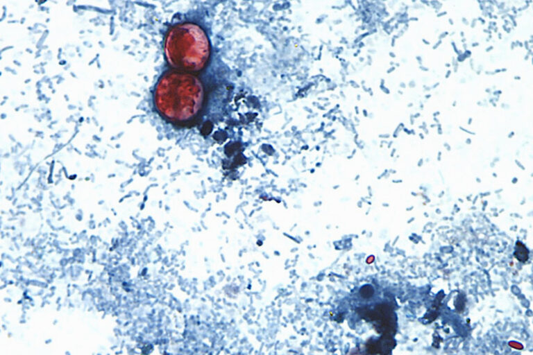 First 2 Deaths Reported in Ongoing US Cyclospora Outbreak